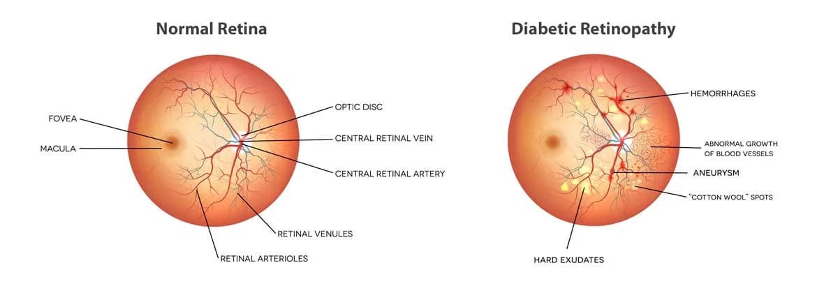 Source: Siskiyou Eye Center